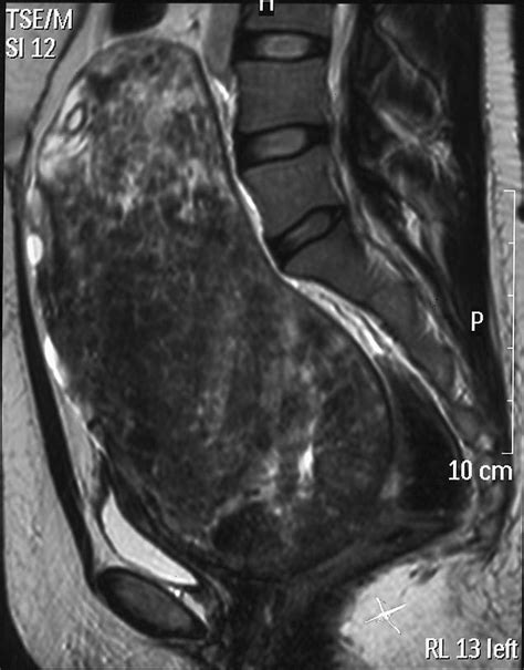 sagittal t2 weighted mr image showing a large fibroid mass extending to