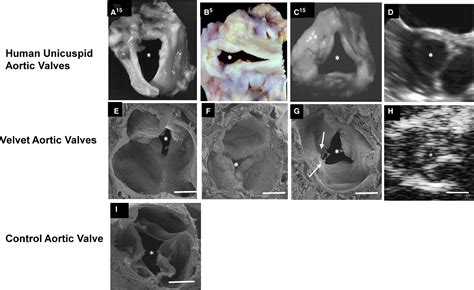 Discovery Of An Experimental Model Of Unicuspid Aortic Valve Journal