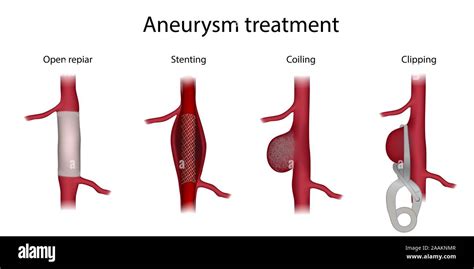aneurysma behandlung illustration vergleich von clipping offene