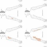 Dermatome sketch template