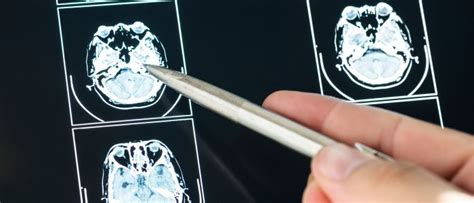 hersenscan  alzheimer vroegtijdig opsporen mijn gezondheidsgids