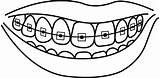 Braces Smile Cavity Dentistry Webstockreview Pngitem Clipartmag sketch template