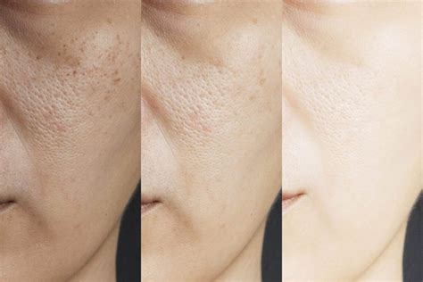 Treatments For Enlarged Pores In London Omniya Clinic