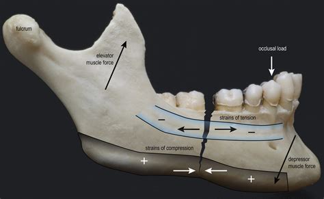 mandibular fracture repair
