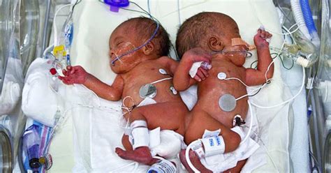 Conjoined Twins Separated After 13 Hour Surgery Pictures Cbs News