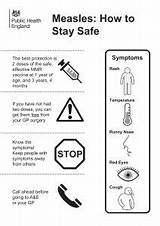 Measles Nhs Symptoms Outbreak Regarding sketch template