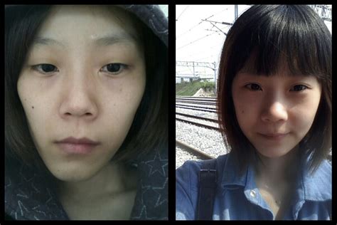 id hospital korea [real review] how i corrected my facial