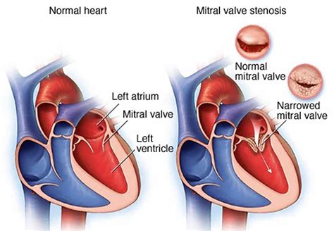 Mitral Valve Disease Hot Sex Picture