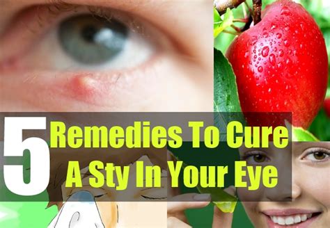 5 home remedies for eye stye how to get rid of a stye in