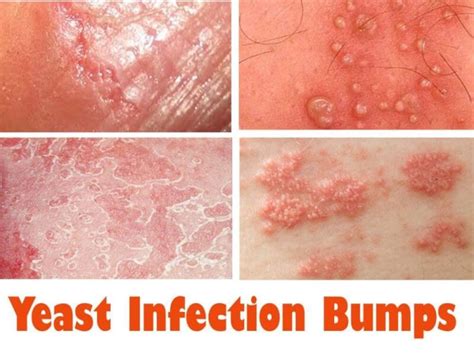 tongue yeast infection images male time heal yourbuzz