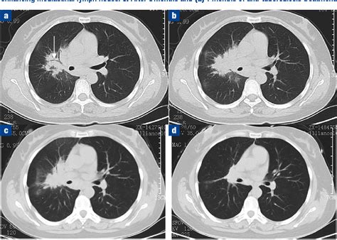 Figure 1 From An Unusual Right Hilar Mass With Enlarged Mediastinal