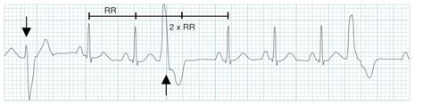 multifocal premature ventricular contractions