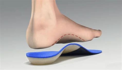 orthotic arch support   price  hyderabad  surgical world id