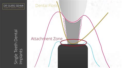 clean     dental implants dr gurs sehmi
