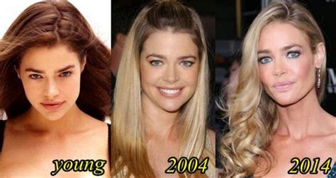 Denise Richards Plastic Surgery Breast Implants Before And