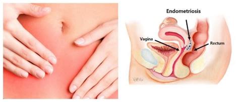 What Is Endometriosis Causes Symptoms And Treatment