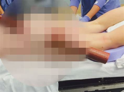 Texting While Driving Woman Impaled Through Buttocks