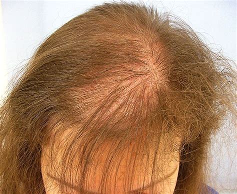 women hair loss treatment  lahore female hair thinning treatment clinic