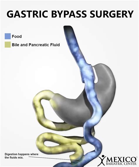 weight gain  rny gastric bypass surgery   fix