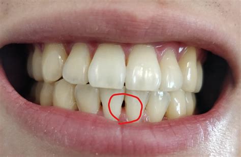 gap   bottom   front teeth  dental scaling   gums eventually