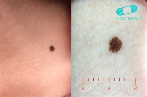 Can You Spot The Cancerous Mole Online Dermatology