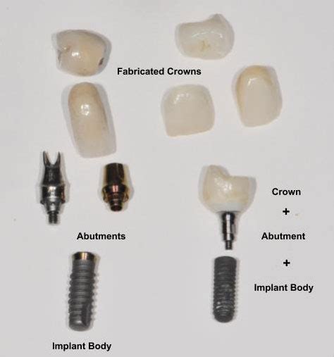dental implant faqs chevy chase md obeid dental