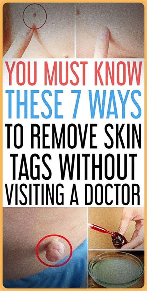 7 easy ways to remove skin tags without visiting a doctor medicine