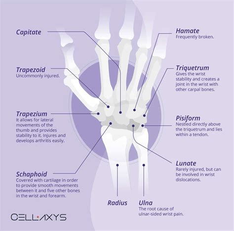 ulnar wrist pain  ulnar shortening osteotomy   ideal cellaxys