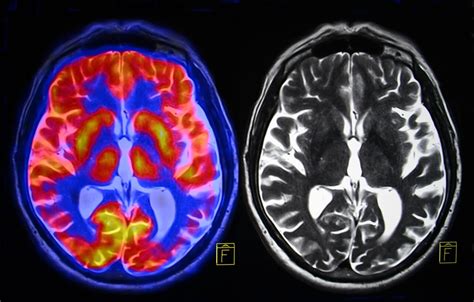 ¿qué es la magnetoencefalografía mejor con salud