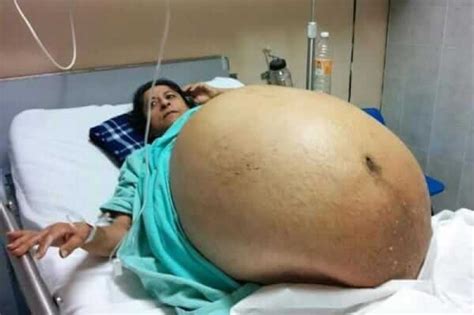 woman survives removal of 132 pound ovarian tumor genetic literacy
