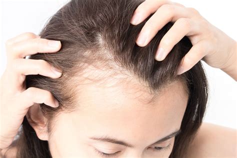 female hair loss and pcos chicago il
