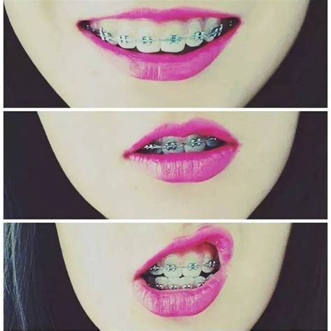 pin de jadeortho en brackets♥ brackets ortodoncia labios