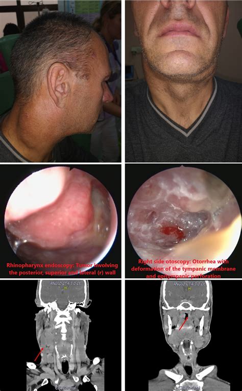 Late Presentation Of Nasopharyngeal Carcinoma Medical