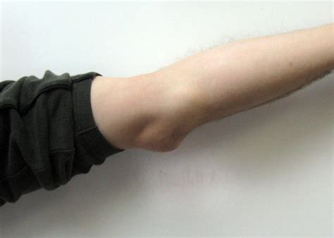 elbow bursitis ive  battling elbow bursitis olecrano flickr