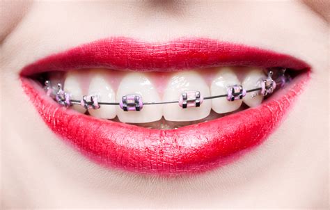 key dental problems braces  fix  adults