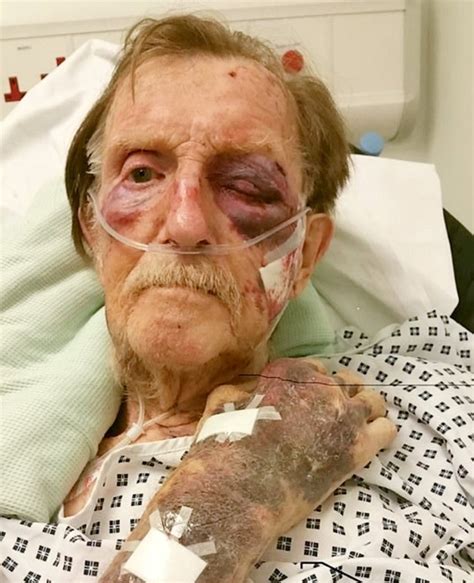 robbery victim 87 reveals injuries after being attacked in his own