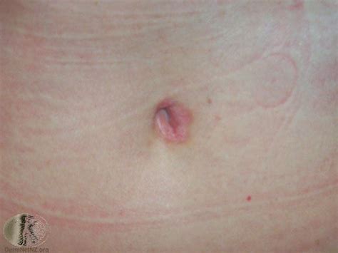 belly button infection adult other hot pics