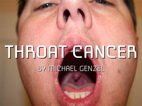 throat cancer by michael genzel