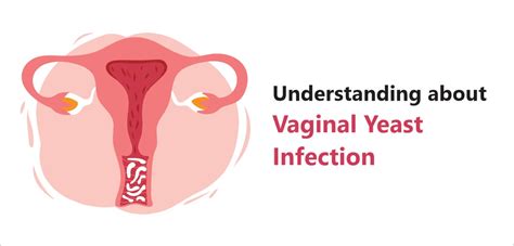 Understanding About Vaginal Yeast Infection Nh Assurance