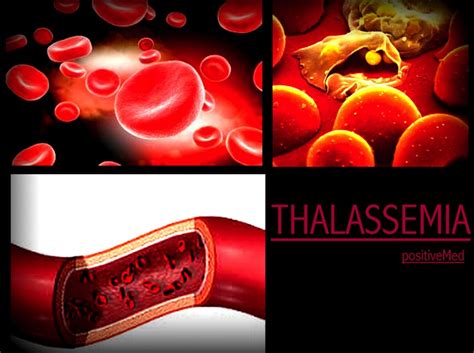 thalassemia symptoms and treatments