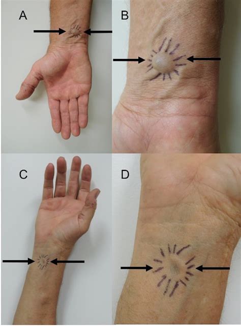 cureus spontaneous venous aneurysm report    traumatic