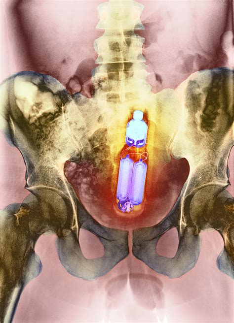 sex toy in man s rectum x ray photograph by du cane