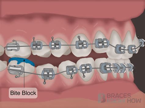 normal      bite   braces