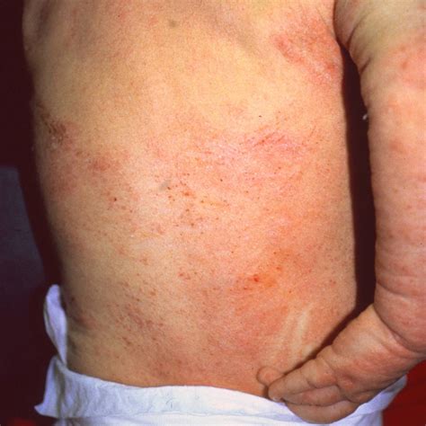 severe eczema  clinical advisor