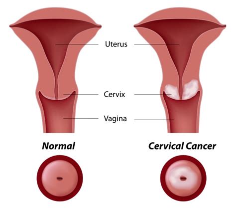 Take Precautions Before Cervical Cancer Symptoms Manifest University