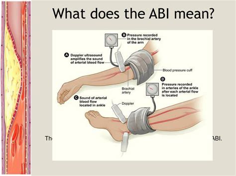 peripheral vascular disease acute chronic limb ischemia powerpoint  id