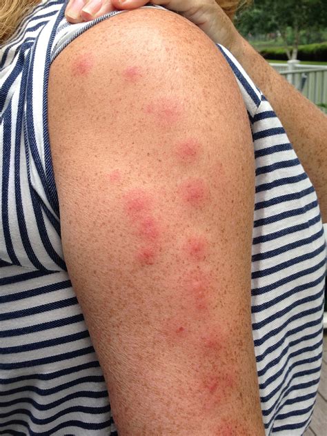 insect bites  bmj