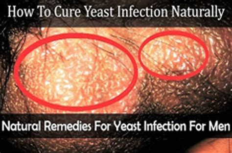 Yeast Infection In Men