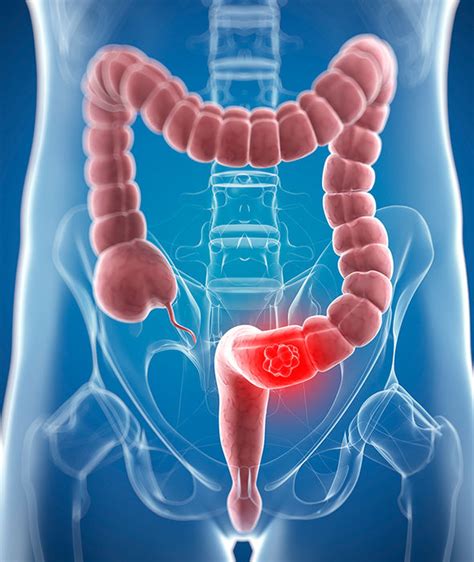 bowel cancer symptoms and signs six potential causes of