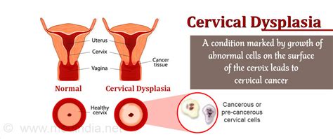 Cervical Dysplasia Causes Symptoms Diagnosis Treatment And Prevention